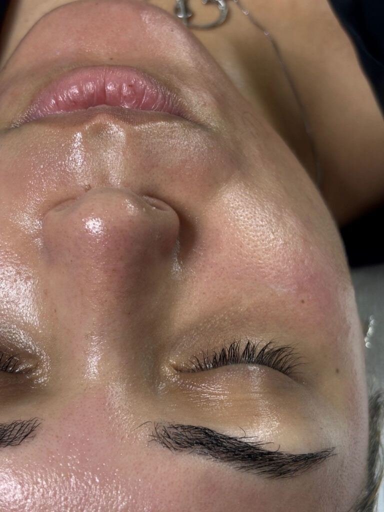 Facial Miami microneedling