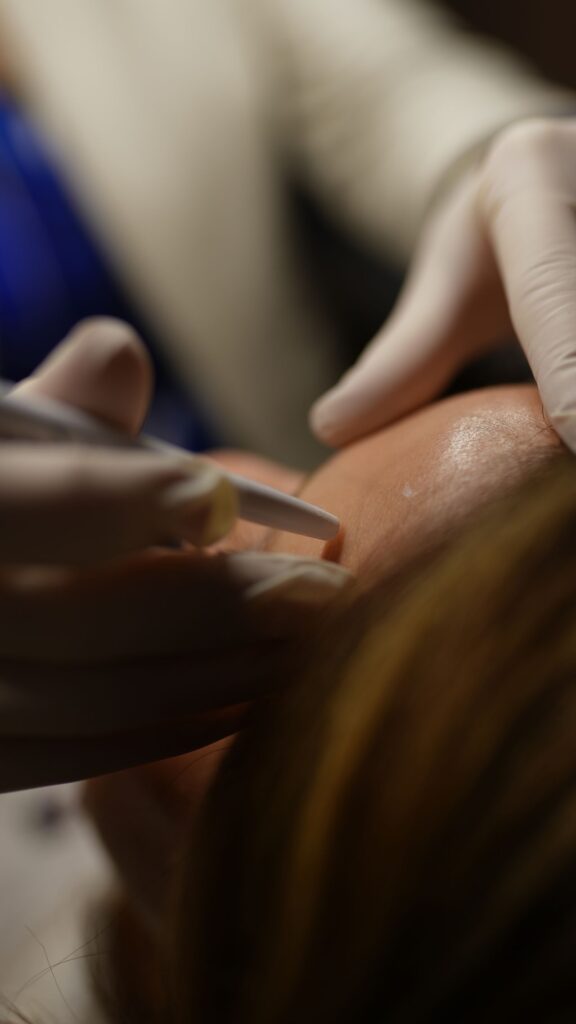 Dermaplaning Miami Lakes